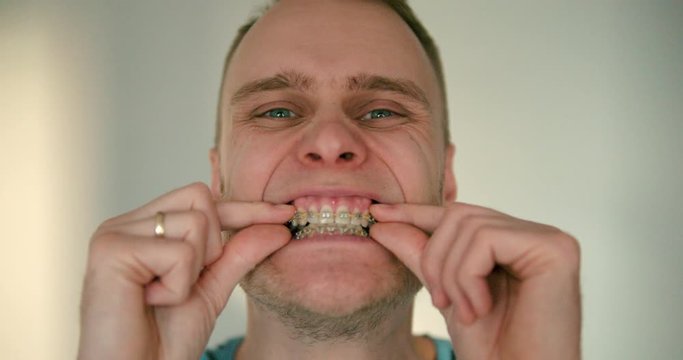 Close up of young man showing his braces and his teeth in slow motion