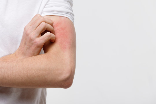Close up of male scratching the itch on his hand, isolated on grey background, copy space. Pruritus, animal/food/cosmetic allergy, dermatitis, insect bites, irritation concept. 