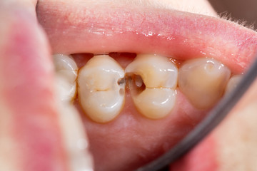 Caries and tooth disease. Filling with a dental composite photopolymer material using Rubber Dam....