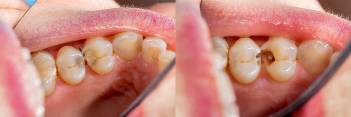 two chewing side teeth of the upper jaw after treatment of caries. Restoration of the chewing...
