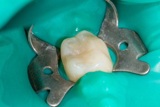 restoration of the tooth with photopolymer filling close-up macro. Caries