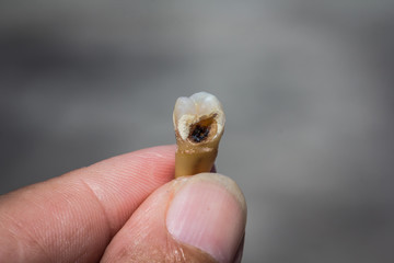 The condition of the tooth decay