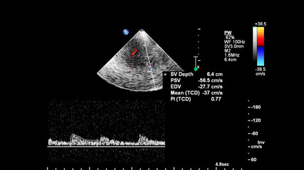 Pulse wave Doppler ultrasound examination of vessels.