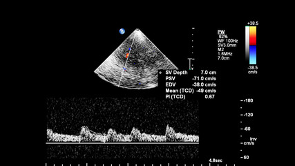 Pulse wave Doppler ultrasound examination of vessels.