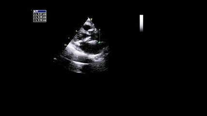 Image of the heart in gray-scale mode during transesophageal ultrasound.