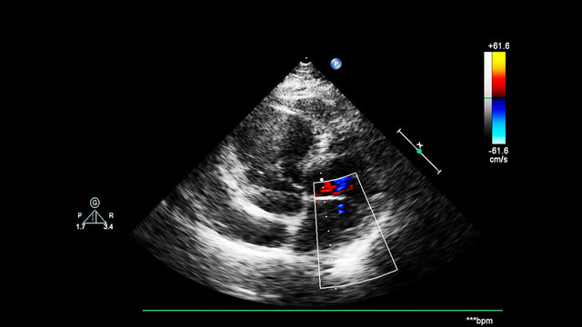 Image of the heart during transesophageal ultrasound with Doppler mode.