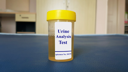 Laboratory sample of urine for Urine analysis test (urinalysis or UA). UA test used to detect,...