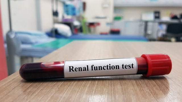 Laboratory sample of blood testing for diagnosis kidney disease. Creatinine(Cr), blood urea nitrogen(BUN) and electrolyte are substance to determine renal function. Medical technology scan concept