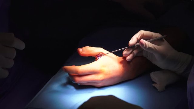 The act of performing surgery may be called a surgical procedure, operation, or simply "surgery". In this context, the verb "operate" means to perform surgery.
