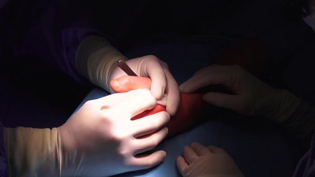 The act of performing surgery may be called a surgical procedure, operation, or simply "surgery". In this context, the verb "operate" means to perform surgery.