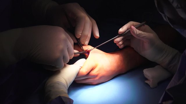 The act of performing surgery may be called a surgical procedure, operation, or simply "surgery". In this context, the verb "operate" means to perform surgery.