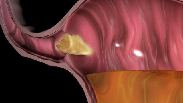 Gastroesophageal Reflux