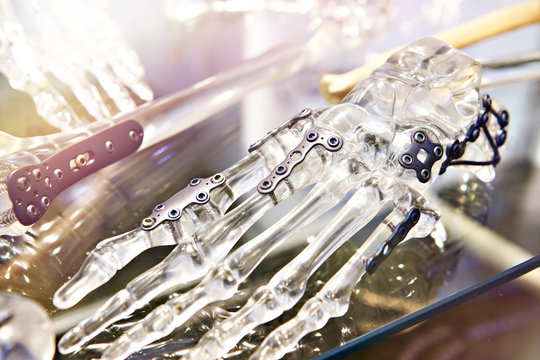 Titanium plates for splicing bones