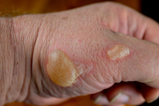 A man has a second degree burn on his hand. Concept: skin burns
