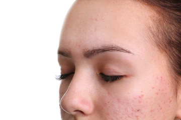Teenage girl with acne problem on white background, closeup