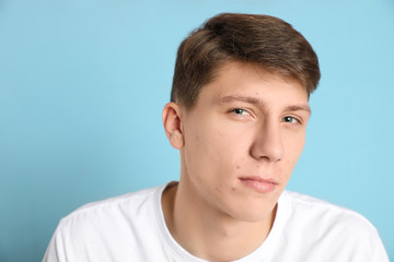Fototapeta premium Teen guy with acne problem on light blue background