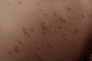 Close up of contact dermatitis rash and skin bumps in Caucasian skin as a result of an allergic...