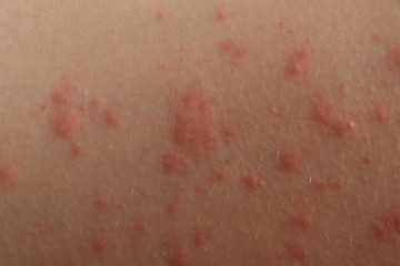 Close up of contact dermatitis rash and skin bumps in Caucasian skin as a result of an allergic reaction - obrazy, fototapety, plakaty