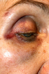 A bruise near the eye. Hematoma on the face from a blow. Eye injury.