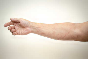 Image of injured arm from a leaf in a hike without protective clothing.