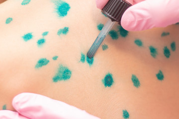 Doctor applies Viride nitens to the body of a child with chickenpox. Varicella. Infectious viral...