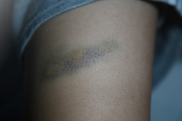 Closeup a Bruise on boy leg skin