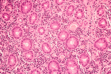 View in microscopic of ductal cell carcinoma, adenonocarcinoma from human breast cancer, tissue...