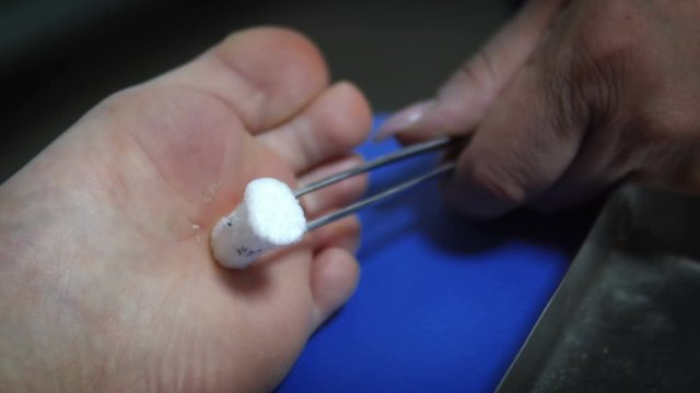 Cryotherapy on parient's foot that is infected with bacterical ulcers