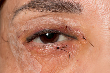 Woman who had eyelift surgery performed on both eyes   