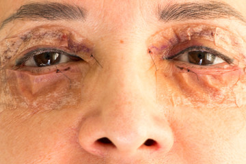 Fototapeta premium Woman who had eyelift surgery performed on both eyes 