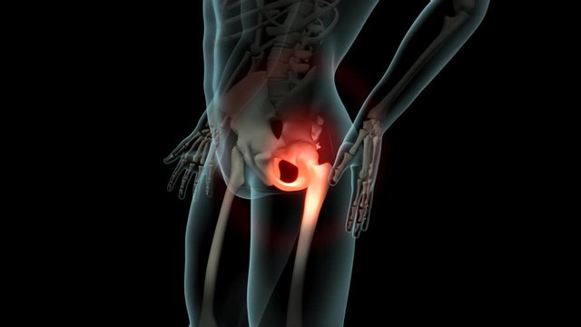 Lateral Hip Pain