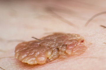 Macro photo of a skin wart, papilloma virus infection