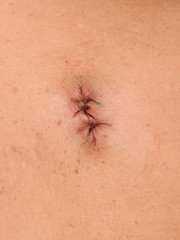 Seam on the body after surgeryand, muscle injury_