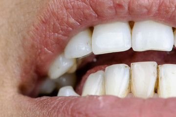 Obraz premium Close up of teeth stained by smoking and drinking coffee