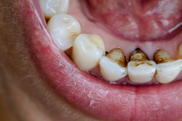 Nicotine and caffeine stains on bottom teeth