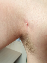 Fototapeta premium large abscess on the body of a man, acne and inflammation, skin diseases