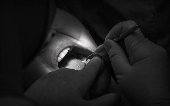 tdentistry. dental treatment, close-up. teeth and caries.
