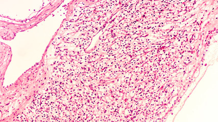 Kidney cancer: Microscopic image of clear cell carcinoma, the most common type of renal cell carcinoma.  It is  characterized by cytoplasmic clearing and a pattern of small branching blood vessels.  
