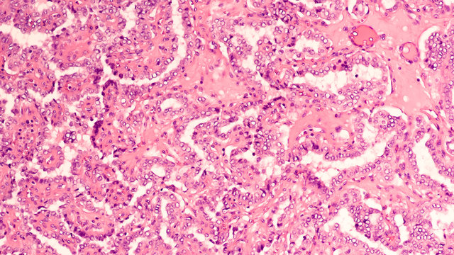 Thyroid gland cancer awareness: Microscopic image of papillary thyroid carcinoma, characterized by branching papillae with fibrovascular cores 