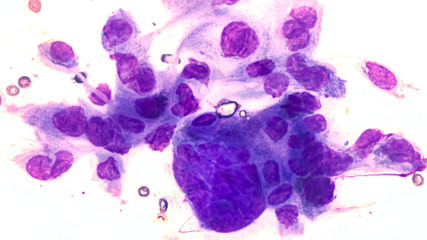 Cytology scraping of a skin lesion (Tzanck smear) showing characteristic multinucleated giant cells with molding in a patient with chicken pox (Varicella zoster virus (VZV), a type of herpes virus.   - obrazy, fototapety, plakaty