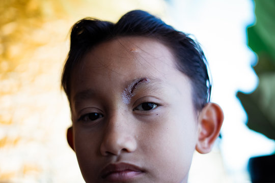 Healed minor cut wound after the surgical glue stiches.  Scar at left eyebrow of Southeast Asian, Malaysian little boy with double eyelid. Health concept.
