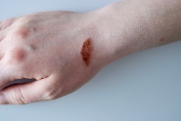 Nasty unpleasant burn on middle-aged white woman's wrist from carelessness from handling hot oven