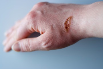 Nasty unpleasant burn on middle-aged white woman's wrist from carelessness from handling hot oven