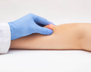 Doctor dermatologist examines the subcutaneous wen on the patient's arm, close-up. The concept of...