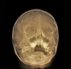 normal radiography of the paranasal sinuses of the facial skull