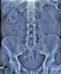 x-ray of the abdominal cavity and pelvis in direct projection, medical research,urography
