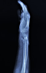 x-ray of the wrist joint with incorrectly fused fractures of the forearm bones, post-traumatic arthritis