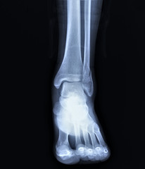 radiograph of the ankle joint  with a fracture of the outer ankle without displacement,...
