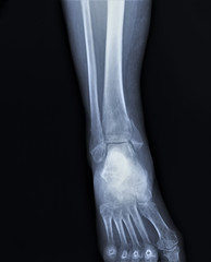 x-ray of the ankle joint with incorrectly fused fracture of the tibia, orthopedics