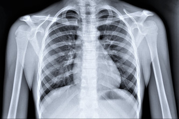 normal radiography of chest organs in direct projection, traumatology and orthopedics, pulmonology
